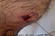 حمله سگ ،واکسیناتور دامپزشکی دورود راراهی بیمارستان کرد